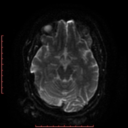 File:Cerebral cavernous malformation (Radiopaedia 26177-26306 Axial DWI 29).jpg