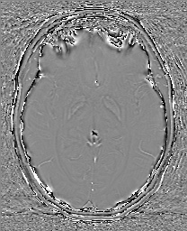 Cerebral cavernous venous malformation (Radiopaedia 70008-80021 G 35).jpg