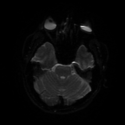 File:Cerebral cavernous venous malformation (Zabramski type II) (Radiopaedia 85511-101198 Axial DWI 77).jpg