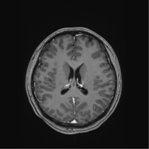 File:Cerebral cavernous venous malformations (Radiopaedia 48117-52946 Axial T1 C+ 37).png