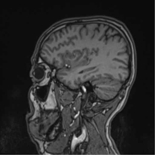 Cerebral fat embolism (Radiopaedia 57697-64639 Sagittal T1 36).png