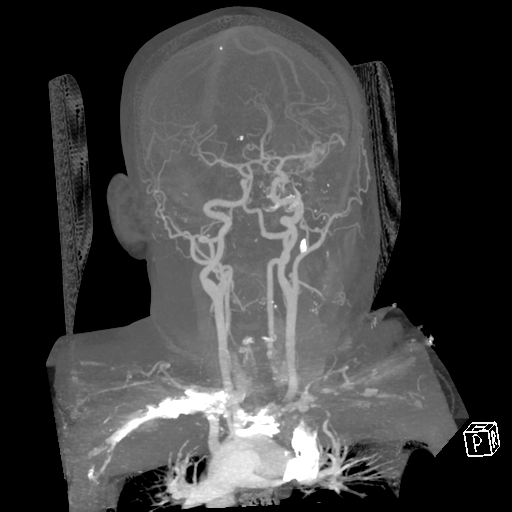 File:Cerebral hemorrhage secondary to arteriovenous malformation (Radiopaedia 33497-34571 A 36).png