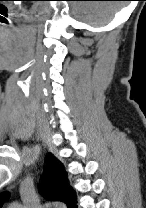 Cerebral hemorrhagic contusions and cervical spine fractures (Radiopaedia 32865-33841 G 71).jpg