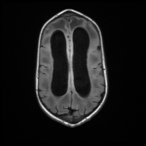 File:Cerebral manifestations of mucopolysaccharidosis type I (Radiopaedia 59171-66487 C 15).jpg