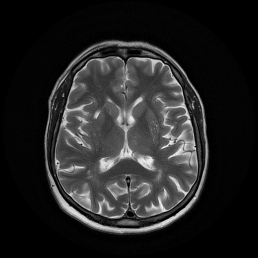 File:Cerebral metastases - melanoma (Radiopaedia 80972-94522 Axial T2 17).jpg