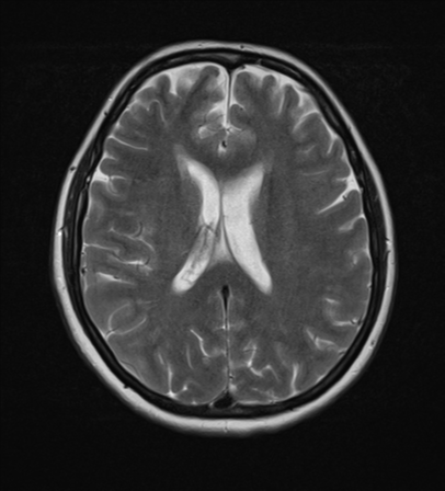 File:Cerebral metastases mimicking abscesses (Radiopaedia 45841-50131 Axial T2 18).png