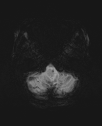 File:Cerebral metastasis (Radiopaedia 46744-51248 Axial SWI 4).png