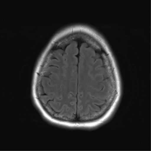 File:Cerebral metastasis mimicking glioblastoma (Radiopaedia 69155-78937 Axial FLAIR 27).png