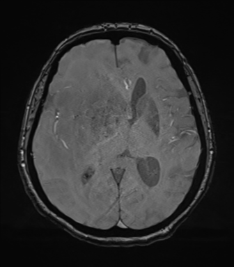 Cerebral metastasis to basal ganglia (Radiopaedia 81568-95413 Axial SWI magnitude 45).png