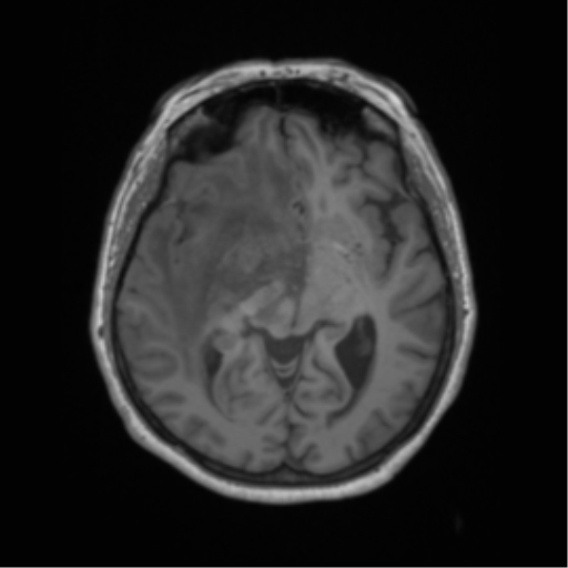 File:Cerebral metastasis to basal ganglia (Radiopaedia 81568-95413 Axial T1 32).png