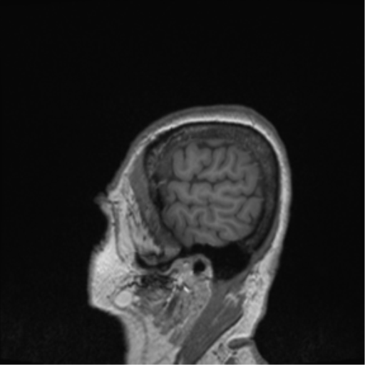 Cerebral metastasis to basal ganglia (Radiopaedia 81568-95413 Sagittal T1 4).png