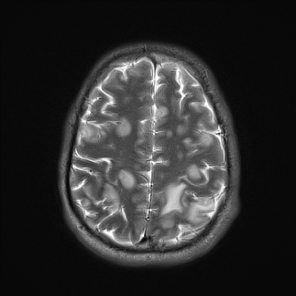 File:Cerebral toxoplasmosis (Radiopaedia 53993-60132 Axial T2 21).jpg