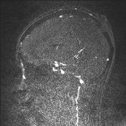 Cerebral tuberculosis with dural sinus invasion (Radiopaedia 60353-68090 Sagittal MRV 86).jpg