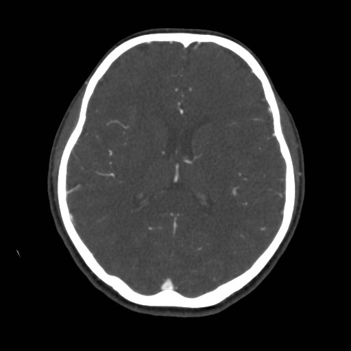 Cerebral venous sinus thrombosis (Radiopaedia 40619-43227 A 131).jpg