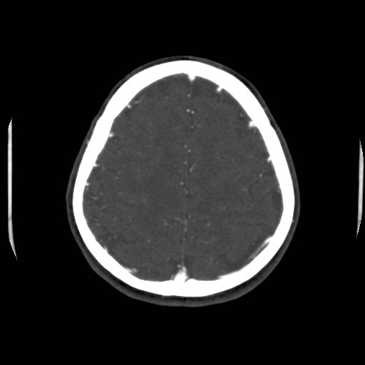 Cerebral venous sinus thrombosis (Radiopaedia 40619-43227 A 182).jpg