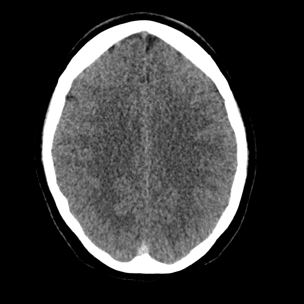 Cerebral venous sinus thrombosis (Radiopaedia 59224-66551 Axial non-contrast 27).jpg