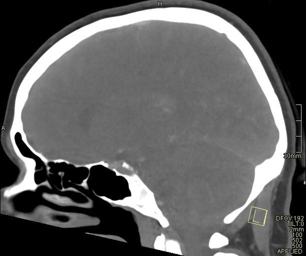 Cerebral venous sinus thrombosis (Radiopaedia 91329-108965 Sagittal venogram 43).jpg