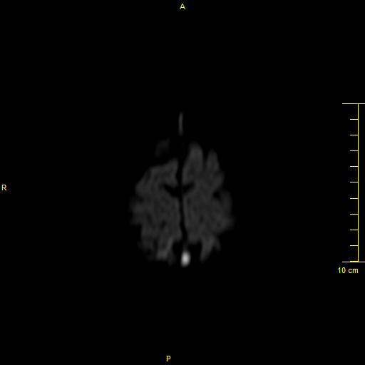 File:Cerebral venous thrombosis (Radiopaedia 23288-23351 Axial DWI 41).JPG
