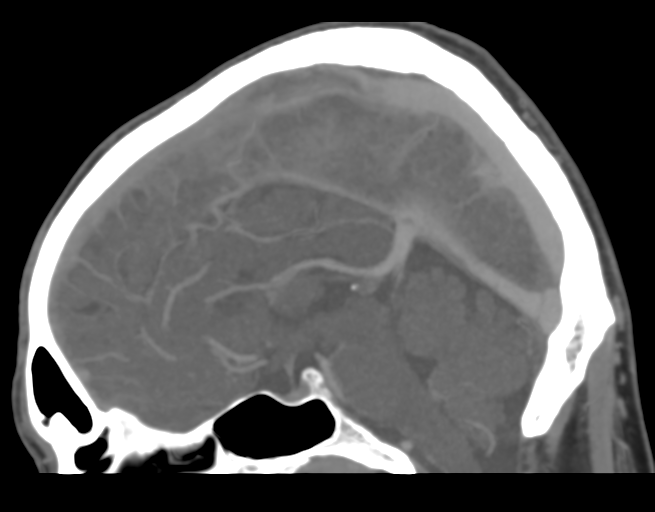 Cerebral venous thrombosis (Radiopaedia 38392-40467 D 27).png