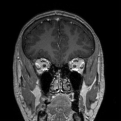 Cerebral venous thrombosis (Radiopaedia 38392-40469 Coronal T1 C+ 70).png