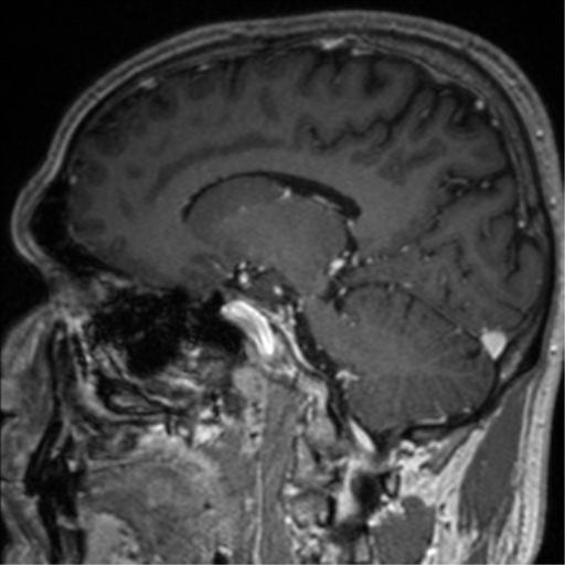 Cerebral venous thrombosis (Radiopaedia 38392-40469 Sagittal T1 C+ 52).png