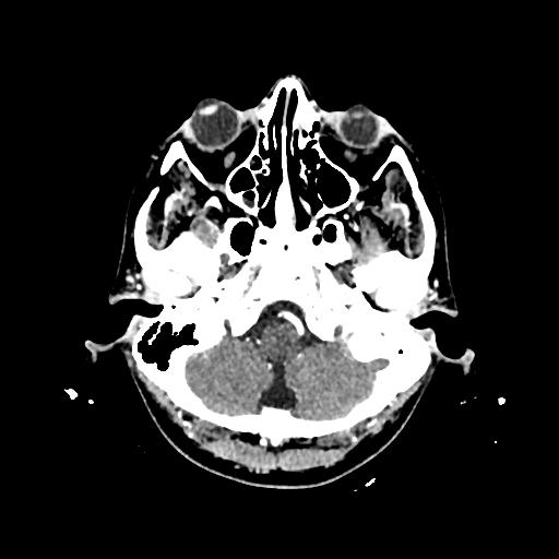 Cerebral venous thrombosis with venous hemorrhagic infarct (Radiopaedia 90354-107660 Axial with contrast 28).jpg