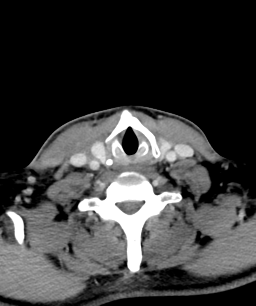 Cervical abscess (Radiopaedia 43725-47184 A 50).png