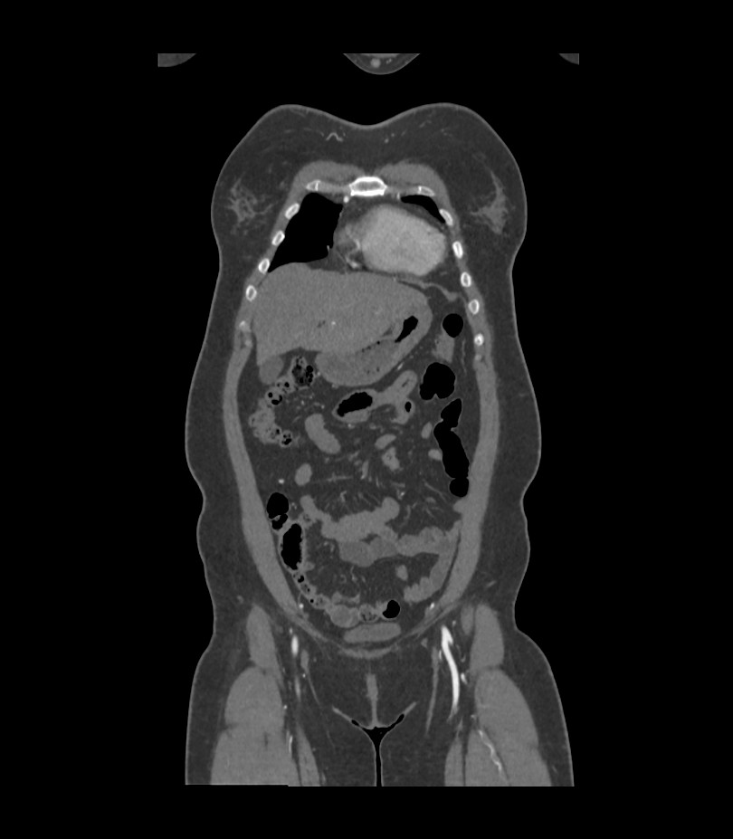 Cervical aortic arch with coarctation and aneurysms (Radiopaedia 44035-47552 C 39).jpg
