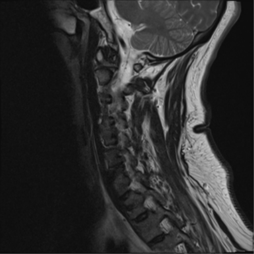 File:Cervical canal stenosis due to ossification of the posterior longitudinal ligament (Radiopaedia 47260-51824 Sagittal T2 4).png