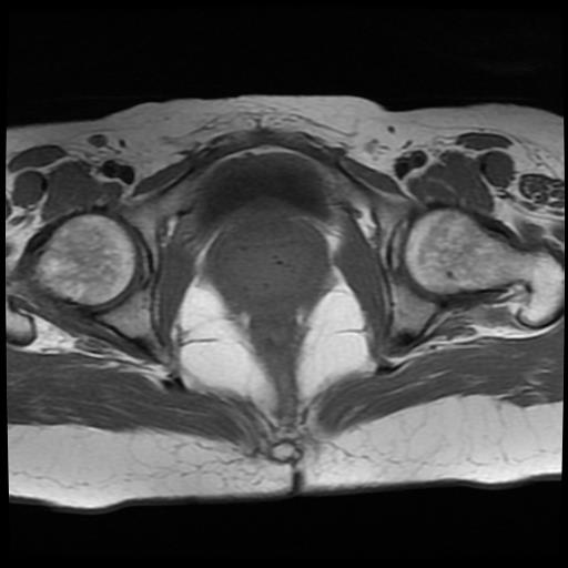 File:Cervical cancer (Radiopaedia 62991-71413 Axial T1 15).jpg