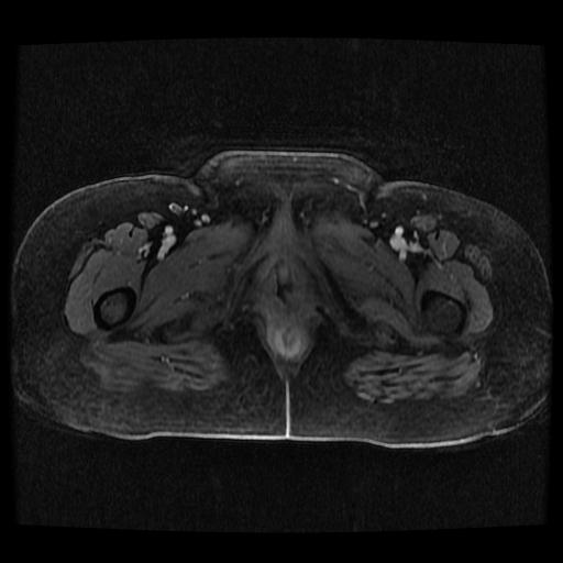 File:Cervical carcinoma (Radiopaedia 70924-81132 Axial T1 C+ fat sat 195).jpg