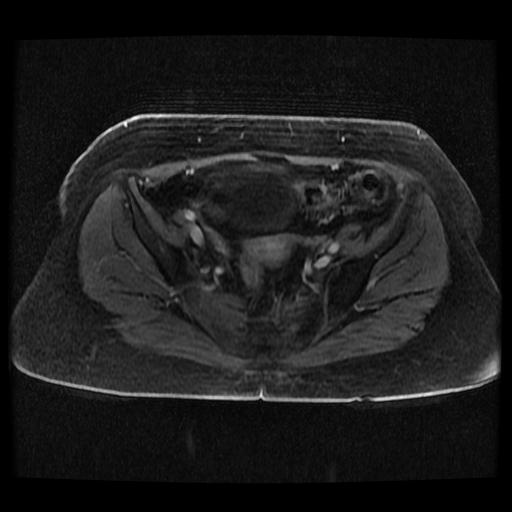 Cervical carcinoma (Radiopaedia 70924-81132 Axial T1 C+ fat sat 238).jpg