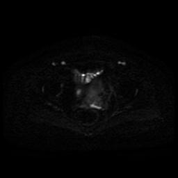 Cervical carcinoma (Radiopaedia 85405-101028 Axial DWI 28).jpg