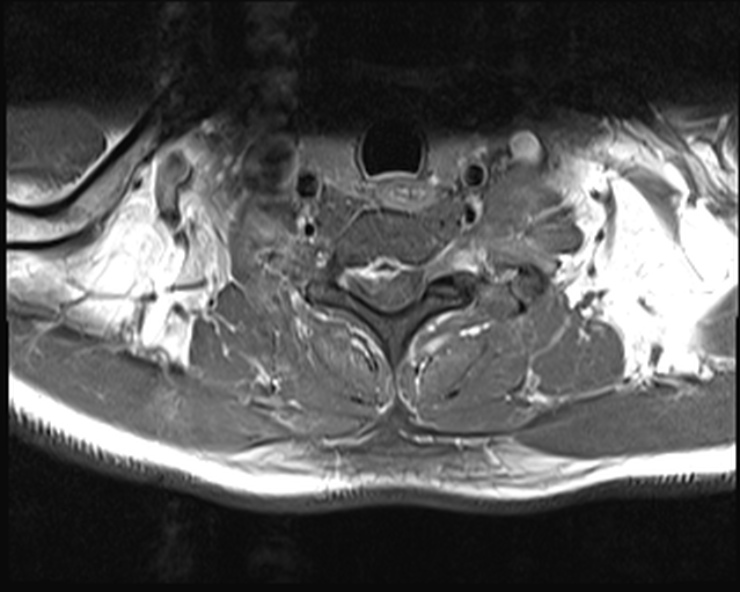 File:Cervical disc extrusion (Radiopaedia 53950-60077 Axial T1 C+ fat sat 23).jpg