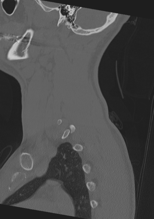 Cervical intercalary bone (Radiopaedia 35211-36748 Sagittal bone window 14).png