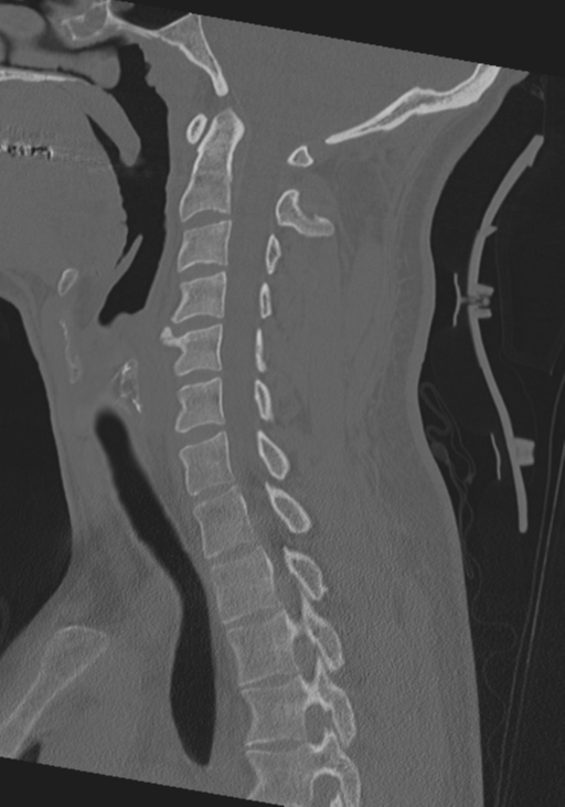 Cervical intercalary bone (Radiopaedia 35211-36748 Sagittal bone window 44).png