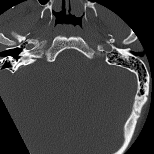 Cervical schwannoma (Radiopaedia 57979-64974 Axial bone window 4).png