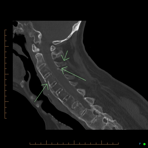 File:Cervical spine fracture - ankylosing spondylitis (Radiopaedia 76835-89037 KEY IMAGES ARROWS 1).jpg