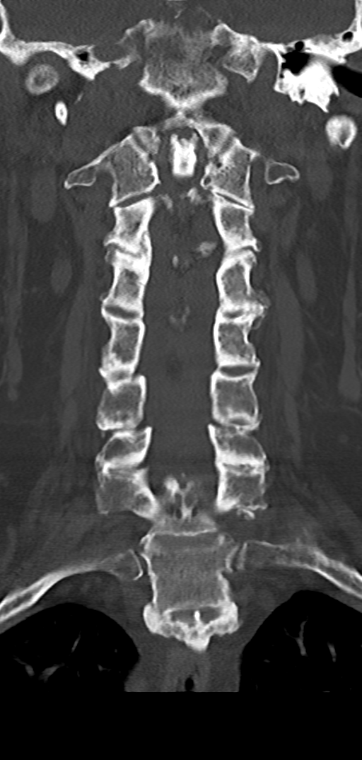 Cervical spine fracture - chalk stick (Radiopaedia 39116-41323 Coronal bone window 24).png