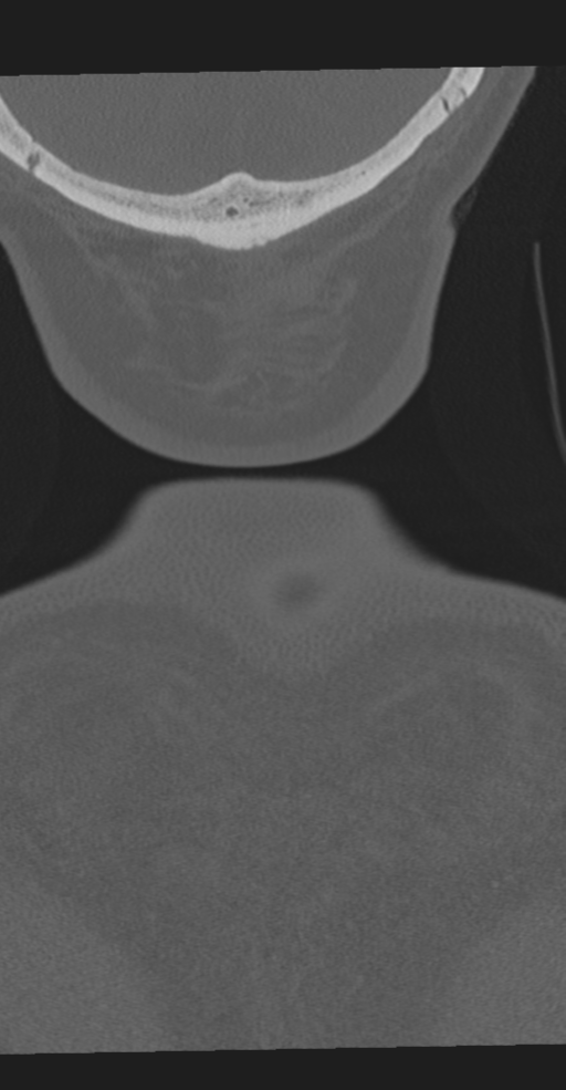 Cervical spine fracture in the setting of ankylosis (Radiopaedia 37038-38715 Coronal bone window 82).png