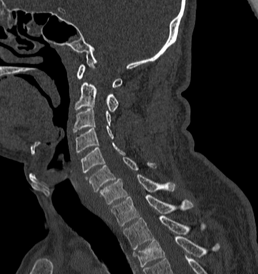 Cervical spine trauma with tear drop fracture and perched facet joint (Radiopaedia 53989-60127 Sagittal bone window 67).jpg