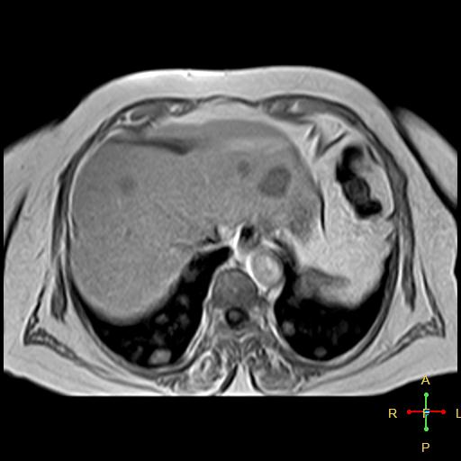 File:Cervical stump squamous cell carcinoma (Radiopaedia 48049-52858 H 16).jpg