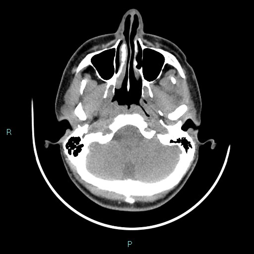 Cervical thymic cyst (Radiopaedia 88632-105335 Axial non-contrast 105).jpg