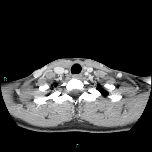 Cervical thymic cyst (Radiopaedia 88632-105335 C 36).jpg