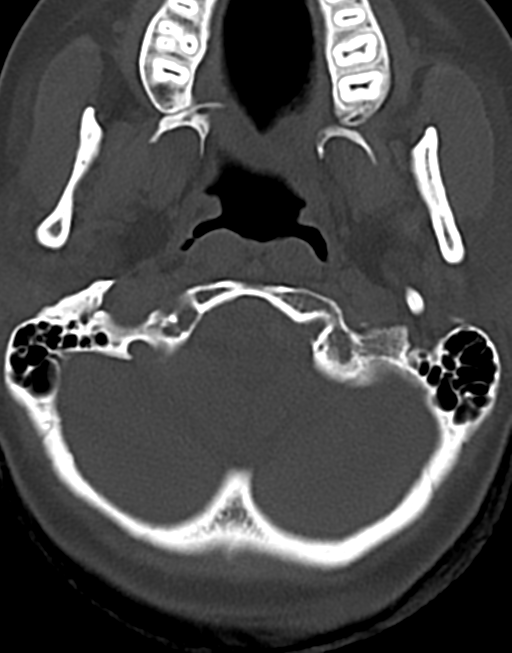 Cervical tuberculous spondylitis (Radiopaedia 39149-41365 Axial bone window 6).png