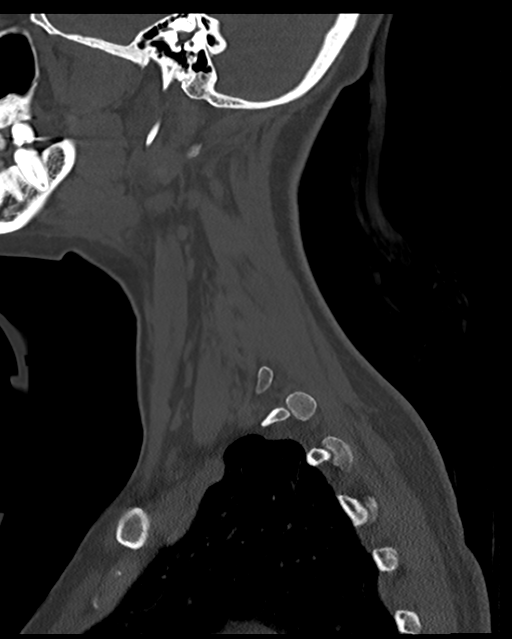 Cervical tuberculous spondylitis (Radiopaedia 39149-41365 Sagittal bone window 14).png