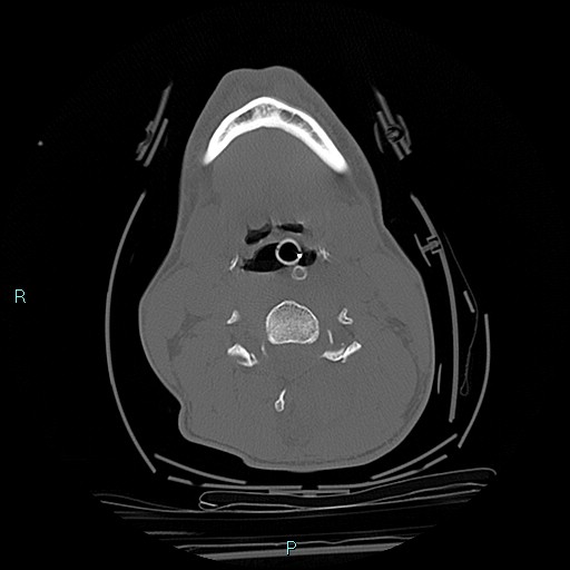 File:Cervical vertebral burst fracture (Radiopaedia 37420-39258 Axial bone window 41).jpg