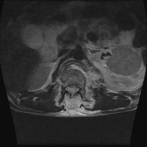 File:Chance type fracture (Radiopaedia 31020-31725 Axial T2 10).jpg