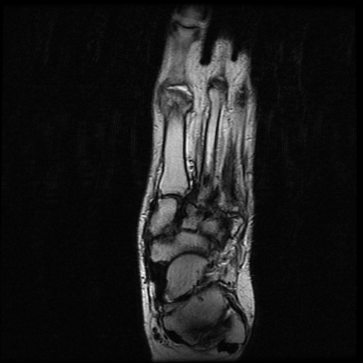 File:Charcot arthropathy (Radiopaedia 55056-61422 Axial T2 15).jpg