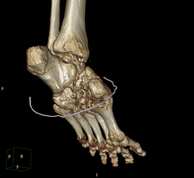 File:Charcot joint (Radiopaedia 36629-38194 3D bone window 6).jpg